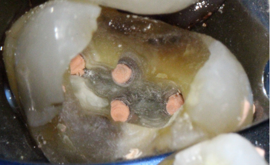 Pulpitis irreversible con periodontitis apical aguda