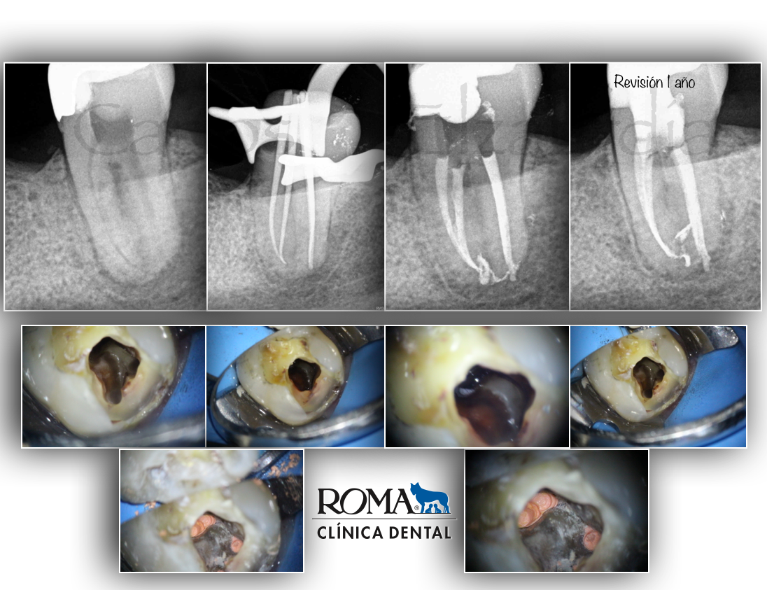 Necrosis pulpar periodontits apical aguda